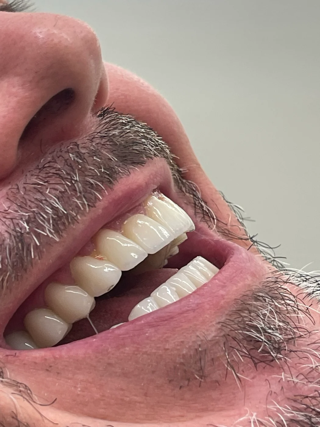 Close-up of teeth following treatment