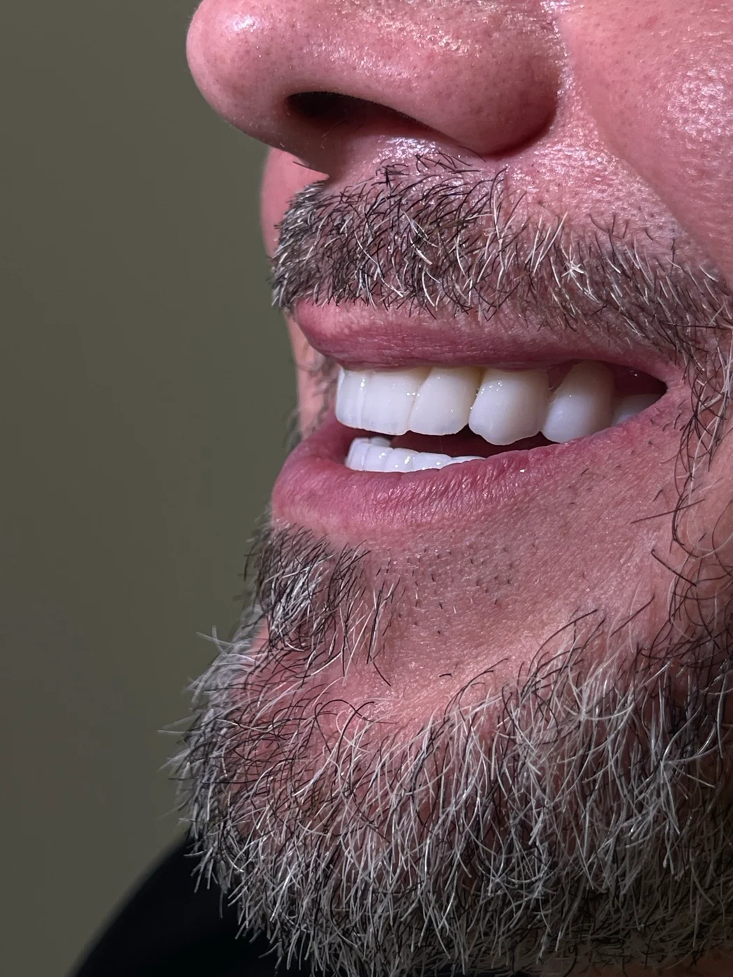 Single implant, front tooth