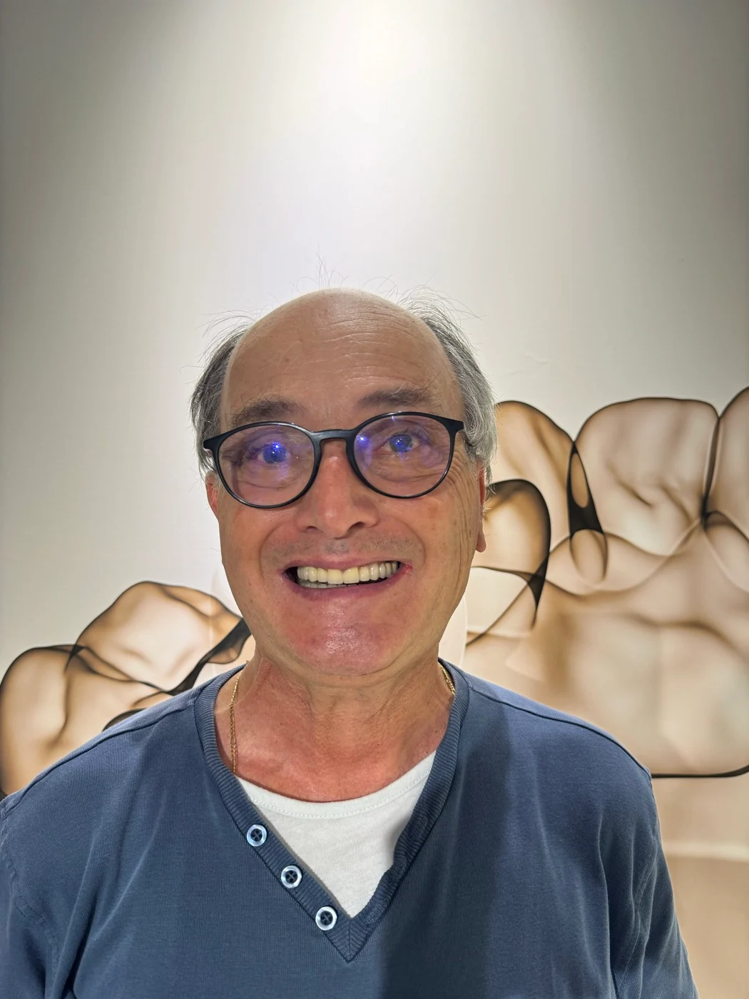 Gap closure with veneers
